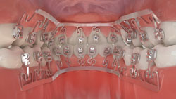 lingual braces